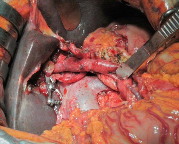 膵癌手術　膵頭十二指腸切除の症例（切除後の写真）