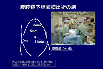 摘出 胆嚢