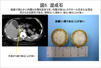 ポリープ 食べ物 胆嚢 消える