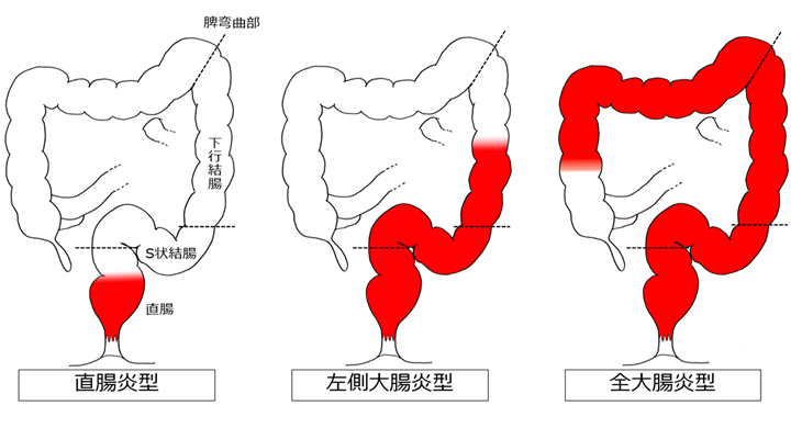 図：潰瘍性大腸炎の病型分類