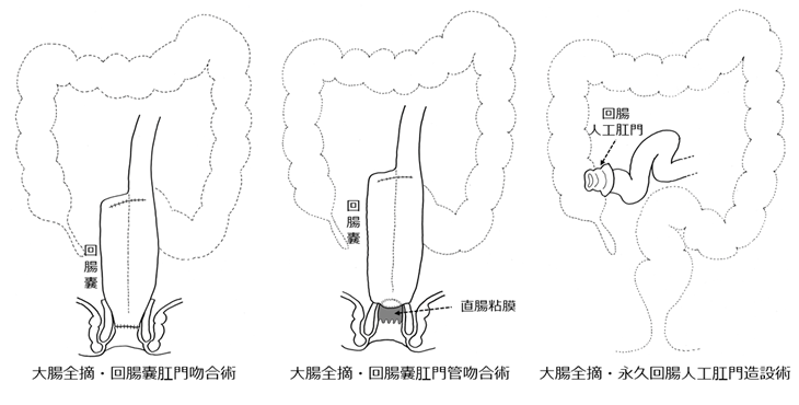 図:潰瘍性大腸炎に対する主な手術形式