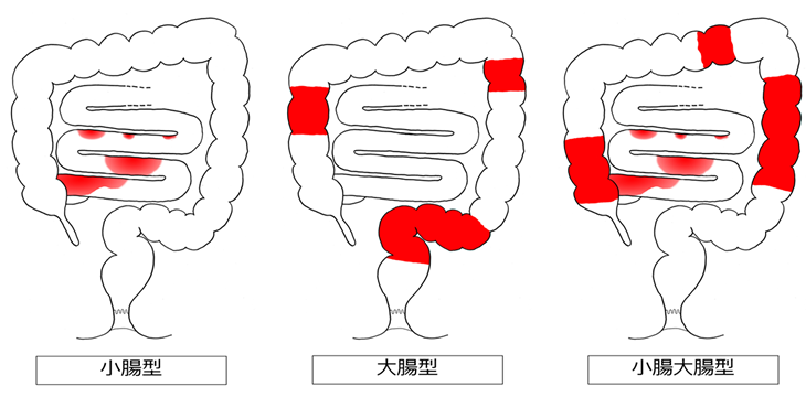 図:病変の存在部位によるクローン病の病型分類