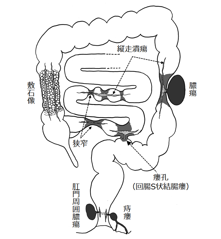 図:クローン病による特徴的な病変