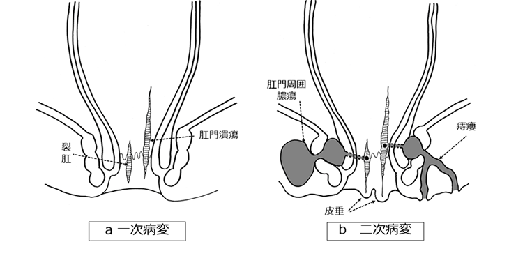 図6:クローン病の肛門病変
